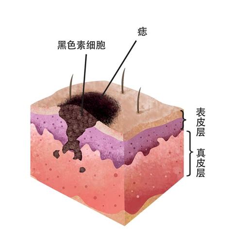 痣是如何形成的|黑痣形成的原因是什么？它对人体有什么危害么？推不推荐把痣去。